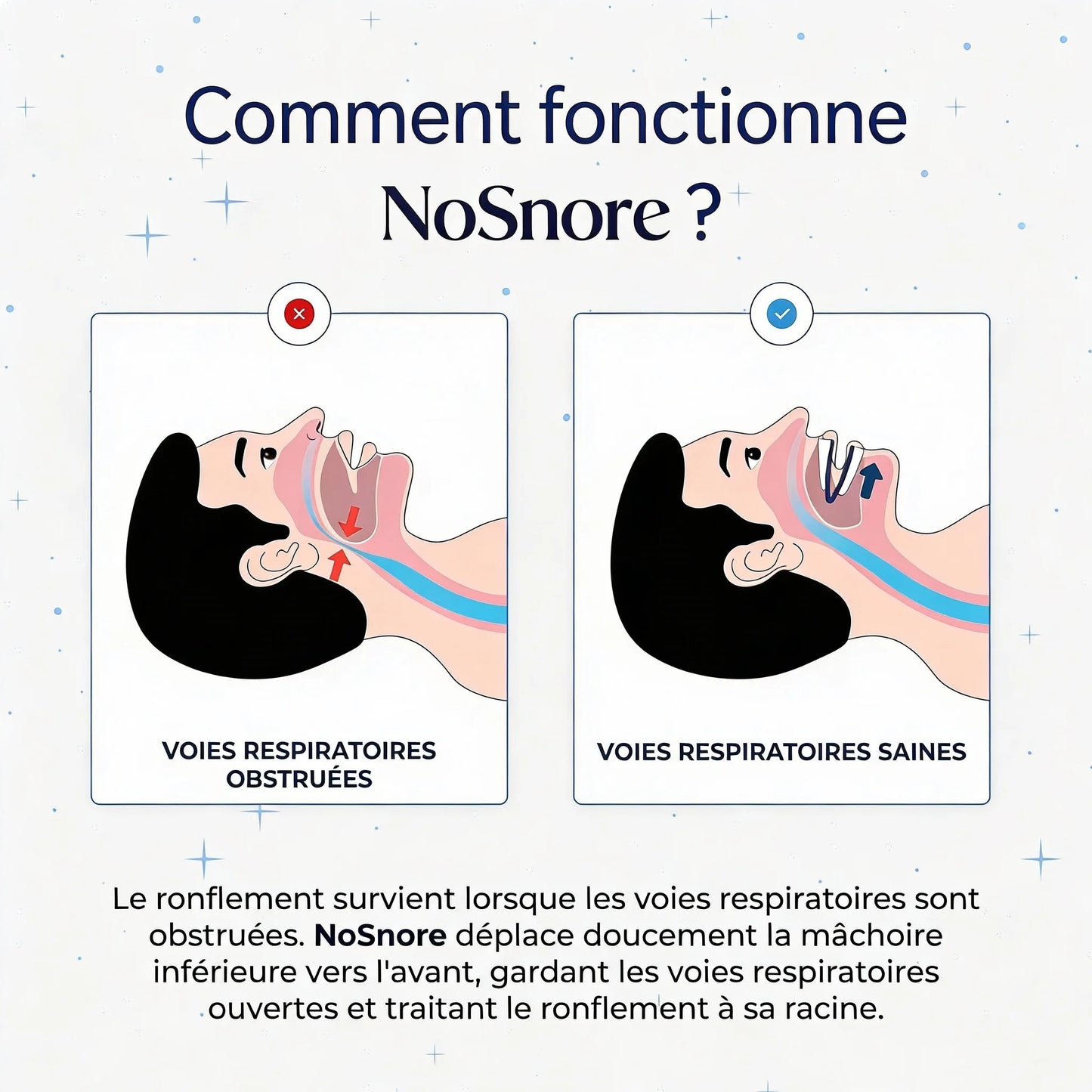 NoSnore — Gouttière anti-ronflement