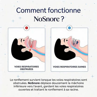 NoSnore — Gouttière anti-ronflement